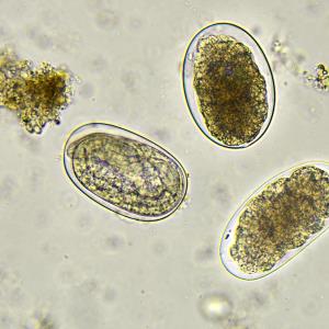 Fixed-dose albendazole–ivermectin combo shows promise in T. trichiura, hookworm infections