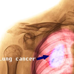 Which TKIs are safe, effective for EGFR-mutated NSCLC?