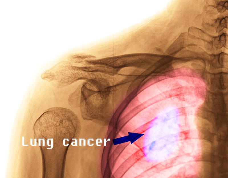 Which TKIs are safe, effective for EGFR-mutated NSCLC?