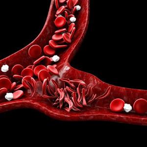 Hydroxyurea for HbSC tied to fewer vaso-occlusive events, hospitalizations