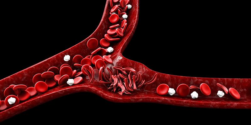 Hydroxyurea for HbSC tied to fewer vaso-occlusive events, hospitalizations