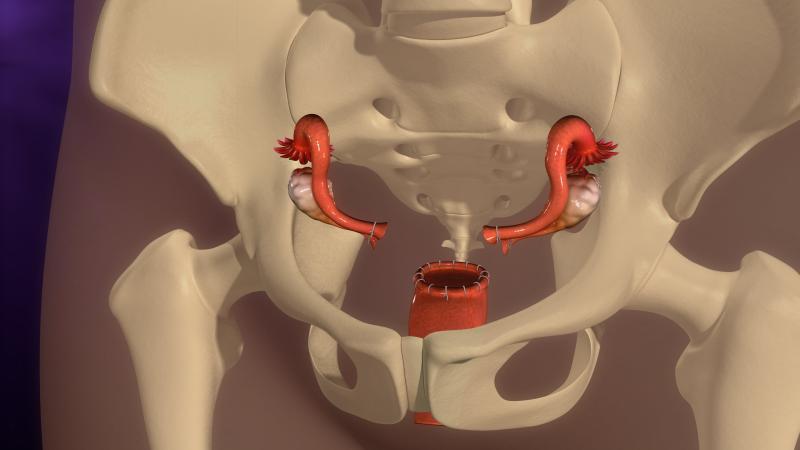 Hysterectomy conveys heightened risk of coronary heart disease