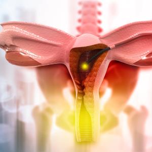 Hysterectomy risk up following endometrial ablation