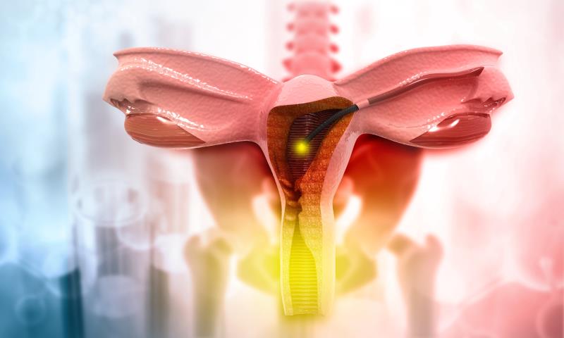 Hysterectomy risk up following endometrial ablation