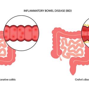 IBD linked to increased risk of hidradenitis suppurativa