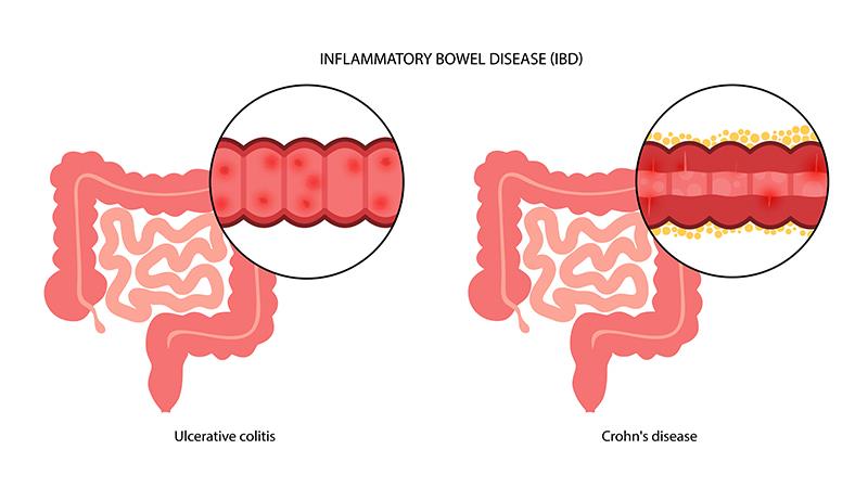 IBD linked to increased risk of hidradenitis suppurativa