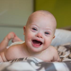 Survival outlook improving for babies with Down syndrome