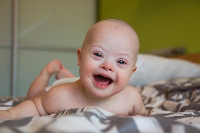 Only two babies with Down Syndrome are born every year in Iceland; mainly due to early terminations as a result from the wide