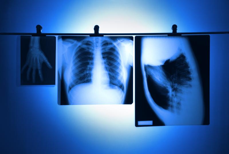 Deep learning using chest radiographs identifies smokers at risk for lung cancer