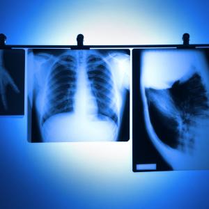 Lung function slightly helps lung cancer prediction in nonsmokers