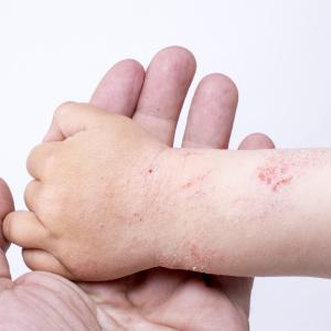 Severe atopic dermatitis tied to worse QOL in children and their caregivers