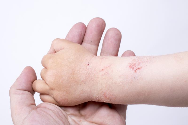 Severe atopic dermatitis tied to worse QOL in children and their caregivers