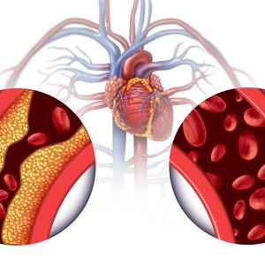 Treat-to-target LDL-C strategy noninferior to high-intensity statin in coronary artery disease