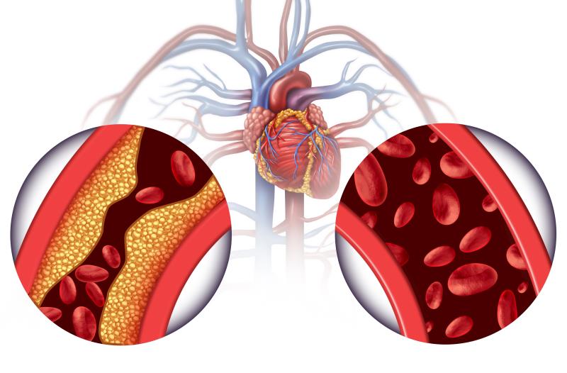 Treat-to-target LDL-C strategy noninferior to high-intensity statin in coronary artery disease