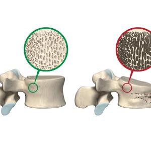 Increased osteoporosis risk in young, gynae cancer survivors