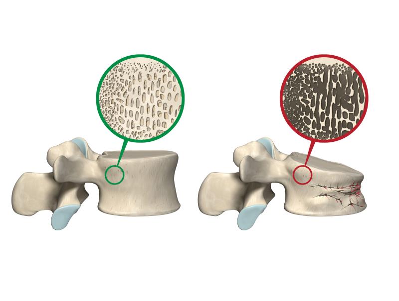 Increased osteoporosis risk in young, gynae cancer survivors