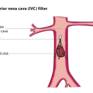 Inferior vena cava ligation comparable to thrombectomy in renal cell carcinoma patients