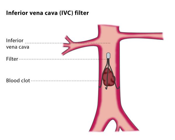 Inferior vena cava filters reduce mortality in patients with pulmonary embolism