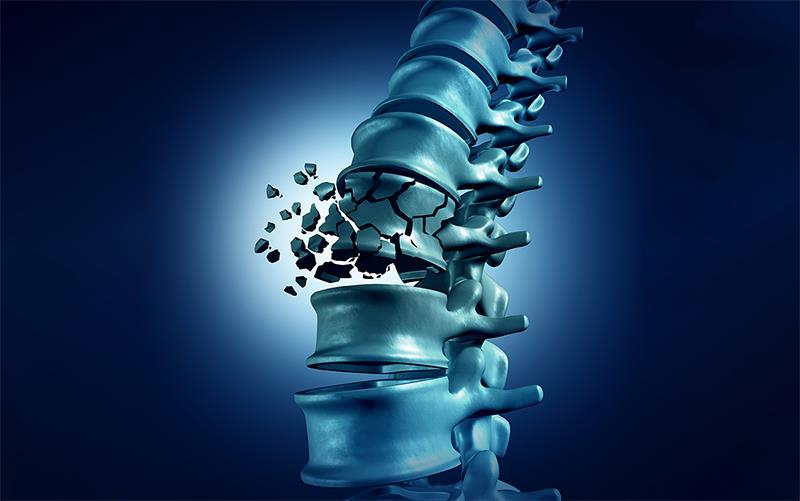 Infrequent zoledronate infusions prevent vertebral fractures in early postmenopausal women