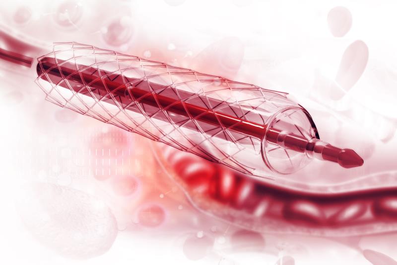 Drug-coated balloon angioplasty may be effective for infrapopliteal disease