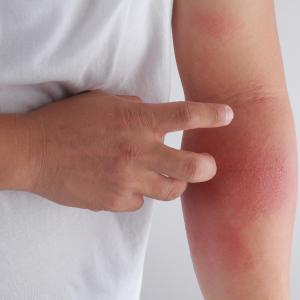 Ruxolitinib effective, safe for atopic dermatitis