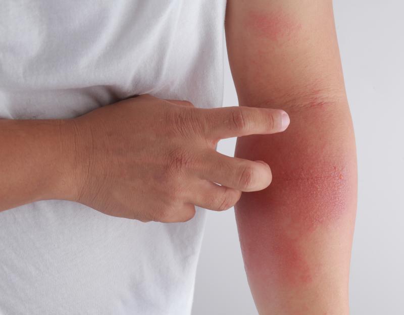 Ruxolitinib effective, safe for atopic dermatitis