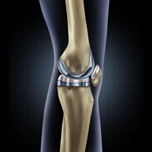 TKR offers good value in obese patients with knee OA