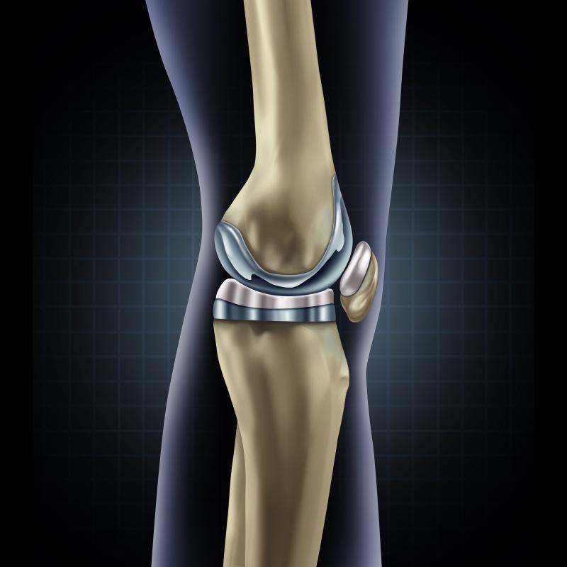 Total knee replacement offers good value in obese patients with knee OA