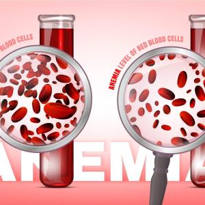 IV iron isomaltoside lowers hypophosphatemia incidence in iron deficiency anaemia