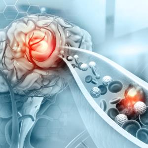 Tirofiban may improve outcomes in LAA strokes