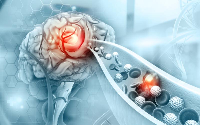 Tirofiban may improve outcomes in LAA strokes