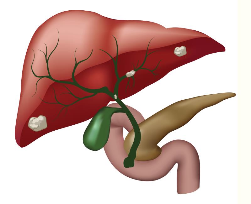 Ivosidenib a ray of hope for rare biliary tract cancer?