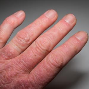 Ixekizumab trumps adalimumab for psoriatic arthritis