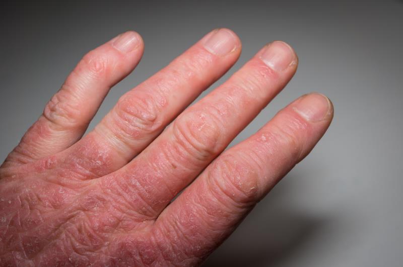 Ixekizumab trumps adalimumab for psoriatic arthritis