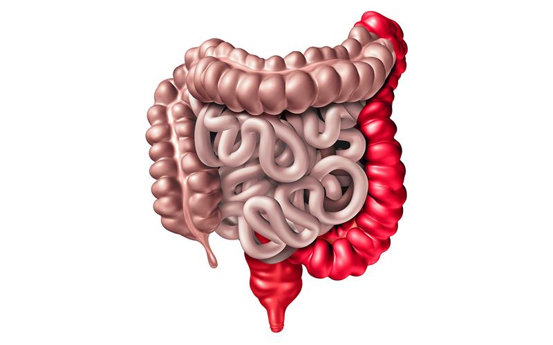 JAK inhibitors tied to high remission rates in older adults with IBD