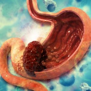 Postoperative complications hurt survival after gastrectomy for gastric cancer