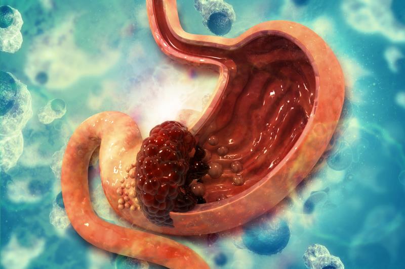 Intensified preoperative treatment doable in advanced gastric cancer patients