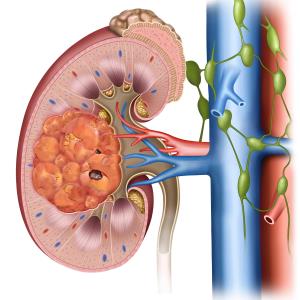 Nivolumab+cabozantinib demonstrates durable efficacy for renal cancer