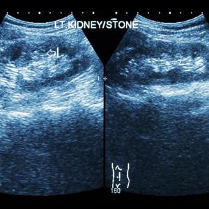 Flexible ureteroscopy slightly better than shock wave lithotripsy for paediatric renal stones