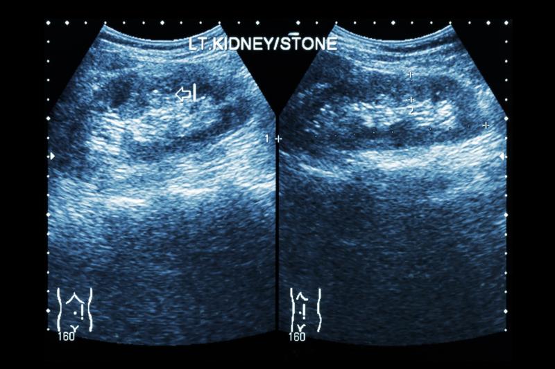 Severe insulin resistance tied to kidney stone formation