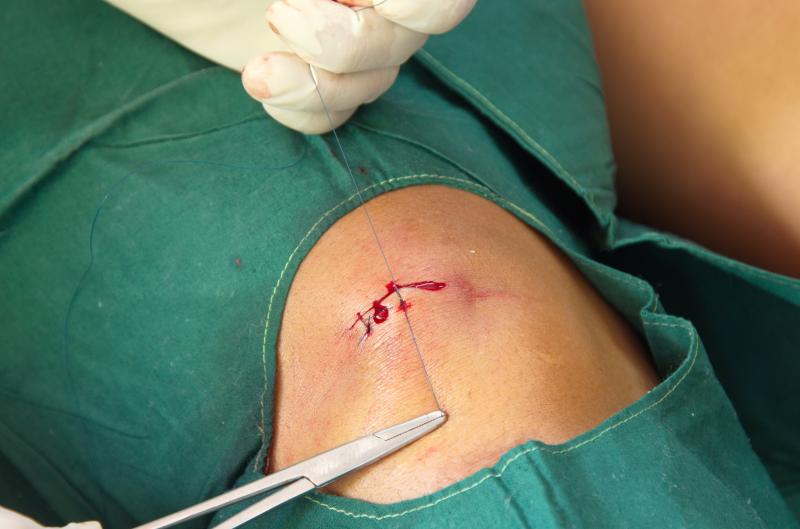 Subcuticular vs horizontal mattress suture: Which is preferable for wound closure?