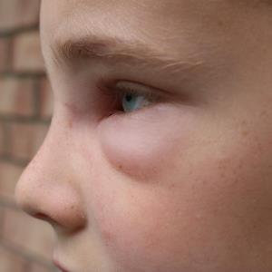 KVD900 shows promise in early trial, gives hope to hereditary angioedema patients