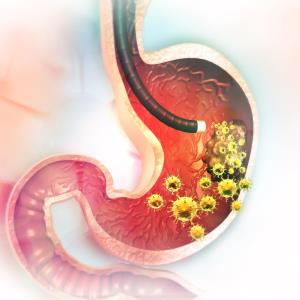 Gastric remnant cancer more common in the West