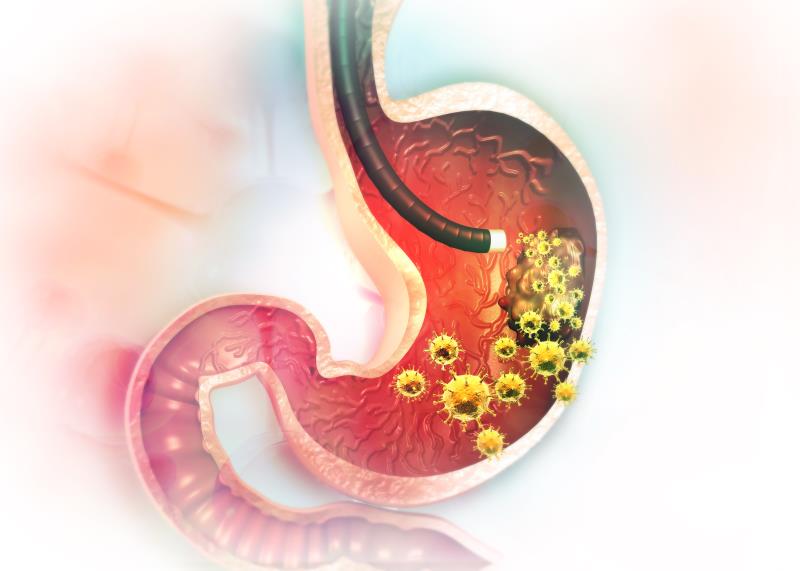 Gastric remnant cancer more common in the West