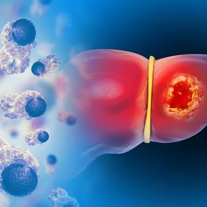 Lenvatinib-pembrolizumab plus TACE promising for intermediate-stage liver cancer