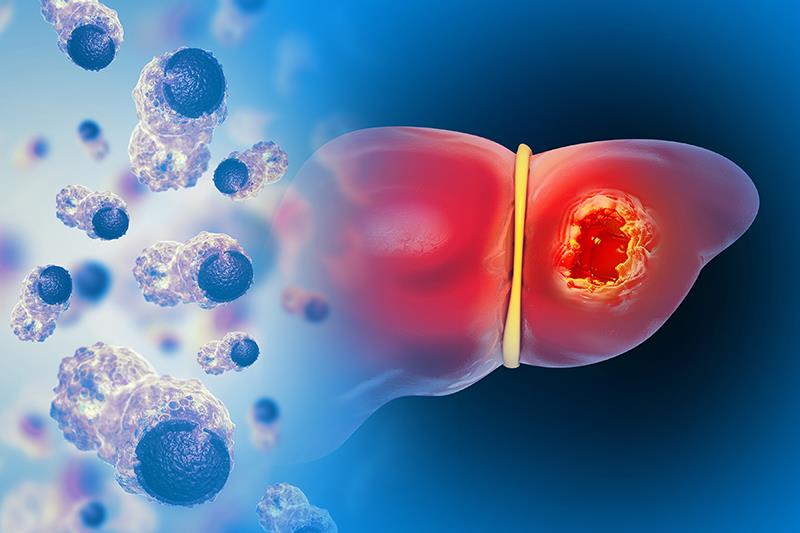 Lenvatinib-pembrolizumab plus TACE promising for intermediate-stage liver cancer