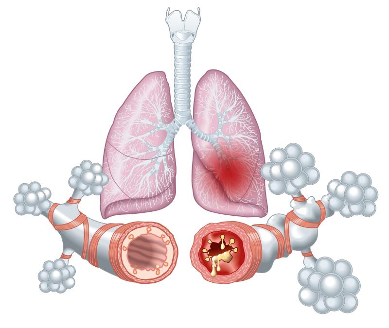 Lebrikizumab reduces asthma exacerbation in adolescents