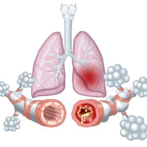 Lebrikizumab reduces asthma exacerbation in adolescents