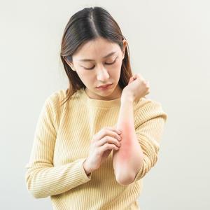 Lebrikizumab relieves itch, skin pain in AD patients previously on dupilumab