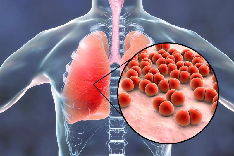 Lefamulin scores again in multilobar pneumonia